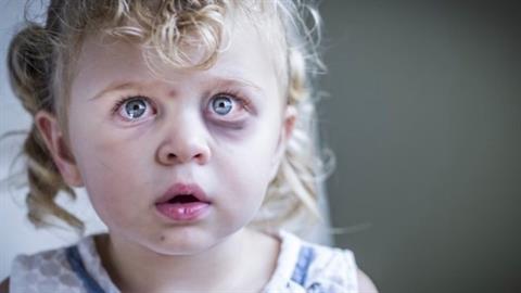 Συνελήφθη πατέρας επειδή χτύπησε την 4χρονη κόρη του - τον κατήγγειλε η μητέρα 